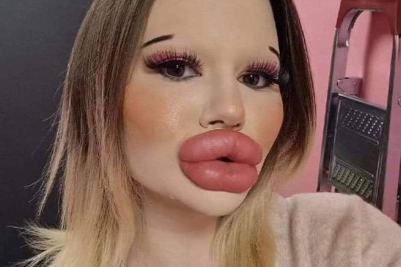 The largest lips in the world are the result of a 25-year-old Bulgarian woman undergoing more than 27 procedures.